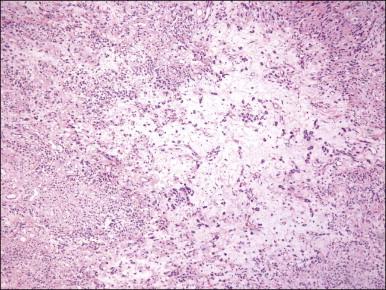 Figure 6.7, Angiomyofibroblastoma. Alternating zones of cellularity are characteristic.
