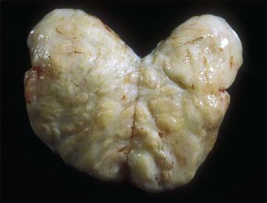 Figure 6.9, Cellular angiofibroma. Bisected solid and well-demarcated, white/tan mass.