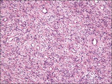 Figure 6.10, Cellular angiofibroma. Numerous medium-sized, thick-walled vessels are surrounded by short intersecting fascicles of bland spindle cells.