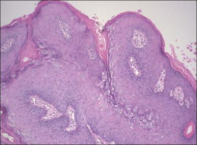 Figure 4.1, Condyloma acuminatum. A complex formation of branching fibrovascular cores is lined by a slightly thickened epithelium with hyperkeratosis apparent on the surface and koilocytic atypia in the superficial third of the epithelium.