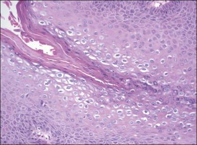 Figure 4.2, Condyloma acuminatum at higher power showing koilocytic atypia and surface parakeratosis.