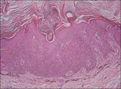 Figure 4.4, Pigmentation of basal cells and numerous squamous eddies in the acanthotic epithelium of seborrheic keratosis.