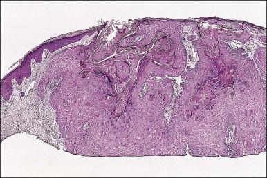 Figure 4.5, Keratoacanthoma at low power, with a ‘buttressing lip’ of normal epidermis visible on the left side of the lesion.