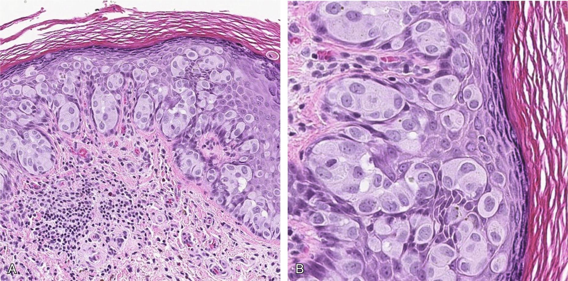 Fig. 19.2, Paget disease cells in nests and clusters involving squamous mucosa (A), Paget cells showing abundant cytoplasm, enlarged nuclei, and prominent nucleoli (B).