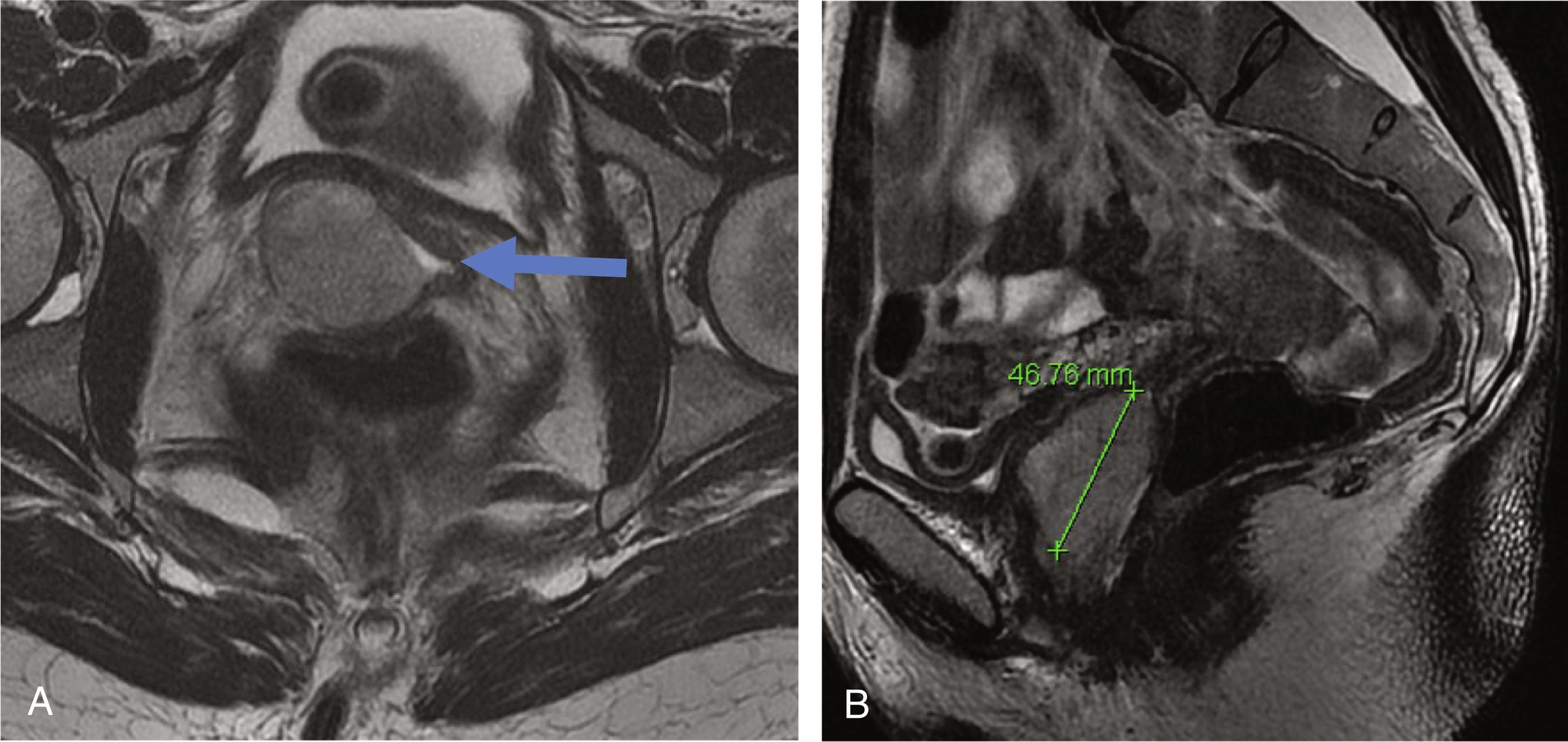 Fig. 17.1, MRI of the pelvis at original presentation. (A) Axial view. (B) Sagittal view.