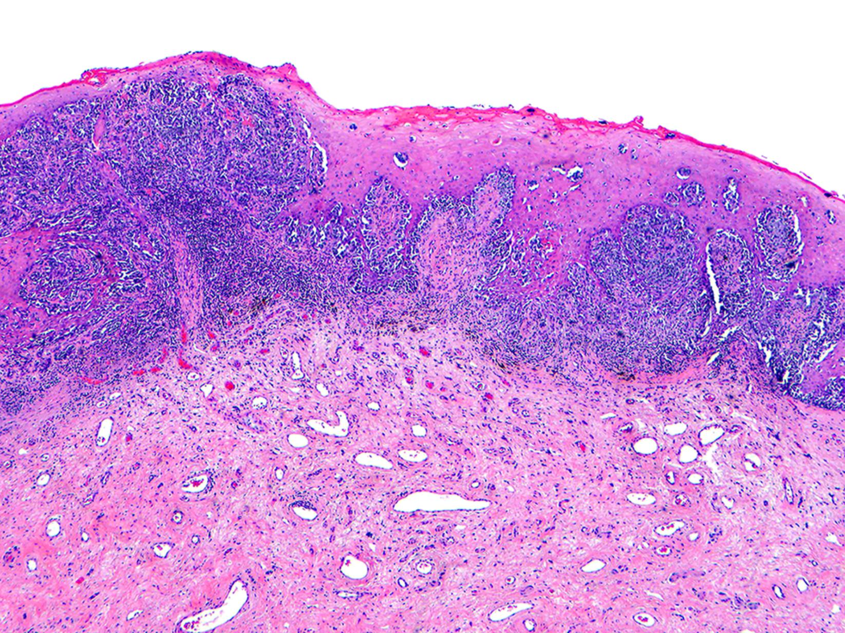 Fig. 17.2, Primary vulvar melanoma with lentiginous pattern of growth, characterized by contiguous proliferation of atypical single melanocytes along the basal layer of stratified squamous epithelium.