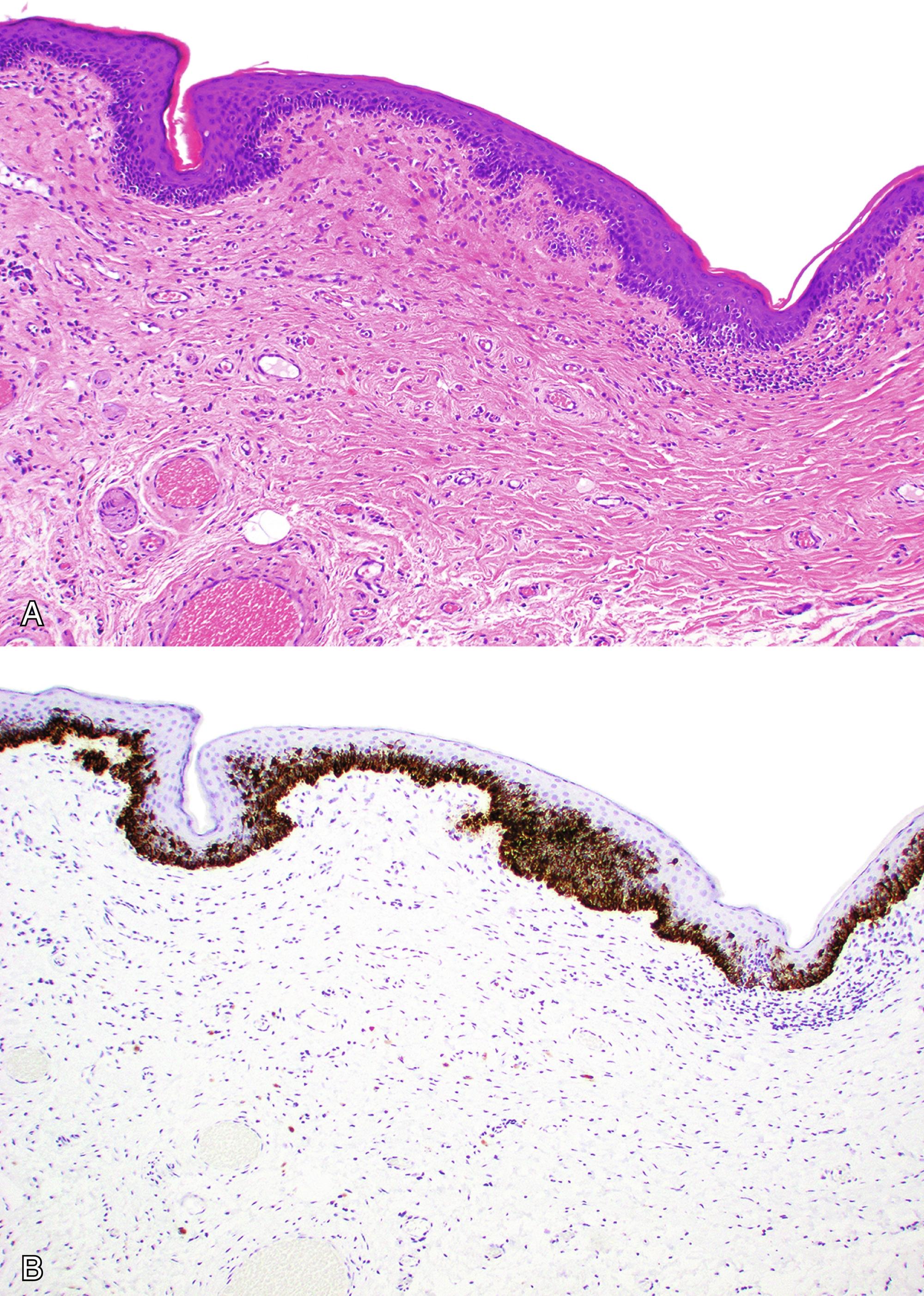 Fig. 17.5, Vulvar melanoma-in situ. (A) Subtle proliferation of small single melanocytes along the basal layer of stratified squamous epithelium with poor circumscription. (B) Melanocytic cocktail (HMB45 and anti-tyrosinase) immunohistochemistry highlights the in situ melanoma.