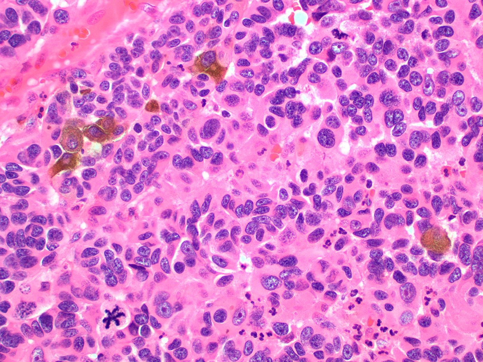 Fig. 17.7, Invasive melanoma with epithelioid cytology, patchy cytoplasmic pigmentation and atypical mitotic figure with multipolar spindle (left lower).