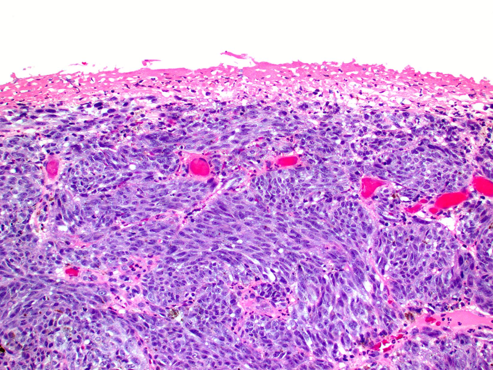 Fig. 17.8, Primary vulvar melanoma with spindled cytology and extensive ulceration.