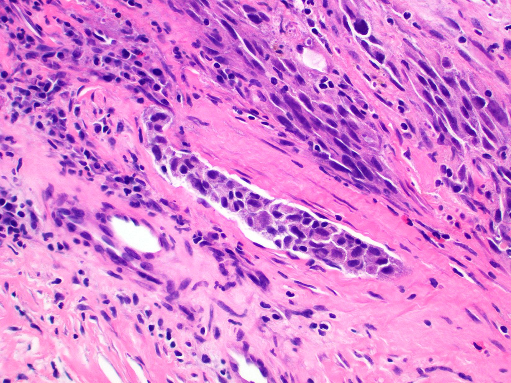 Fig. 17.9, Lymphovascular invasion in primary vulvar melanoma, characterized by presence of atypical cells within lumina lined by flattened endothelial cells.