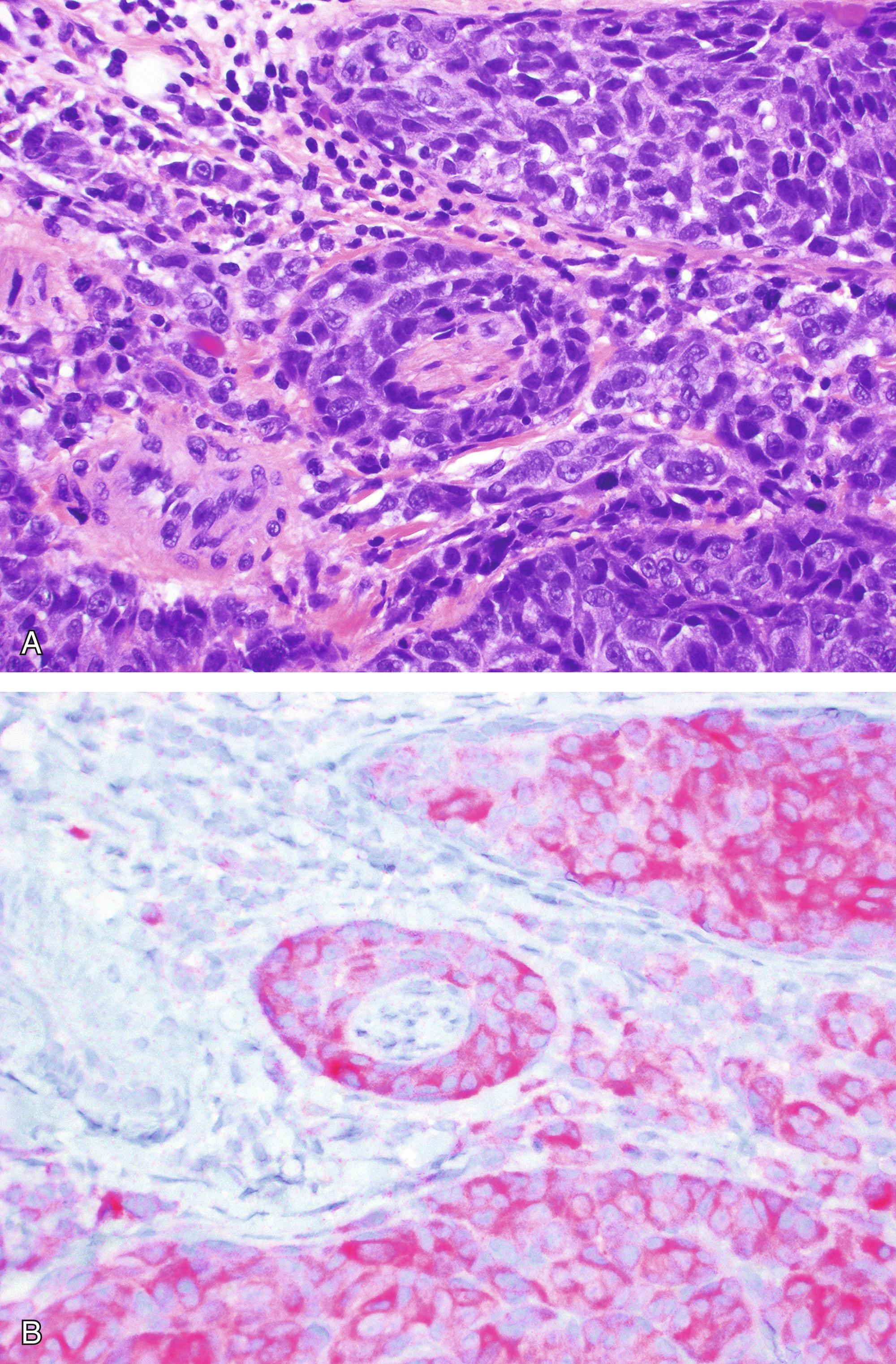 Fig. 17.10, Perineural invasion in primary vulvar melanomas. (A) Small caliber nerve fiber completely encircled by melanoma cells. (B) MART1 immunohistochemical study highlights the melanoma cells and perineural invasion.