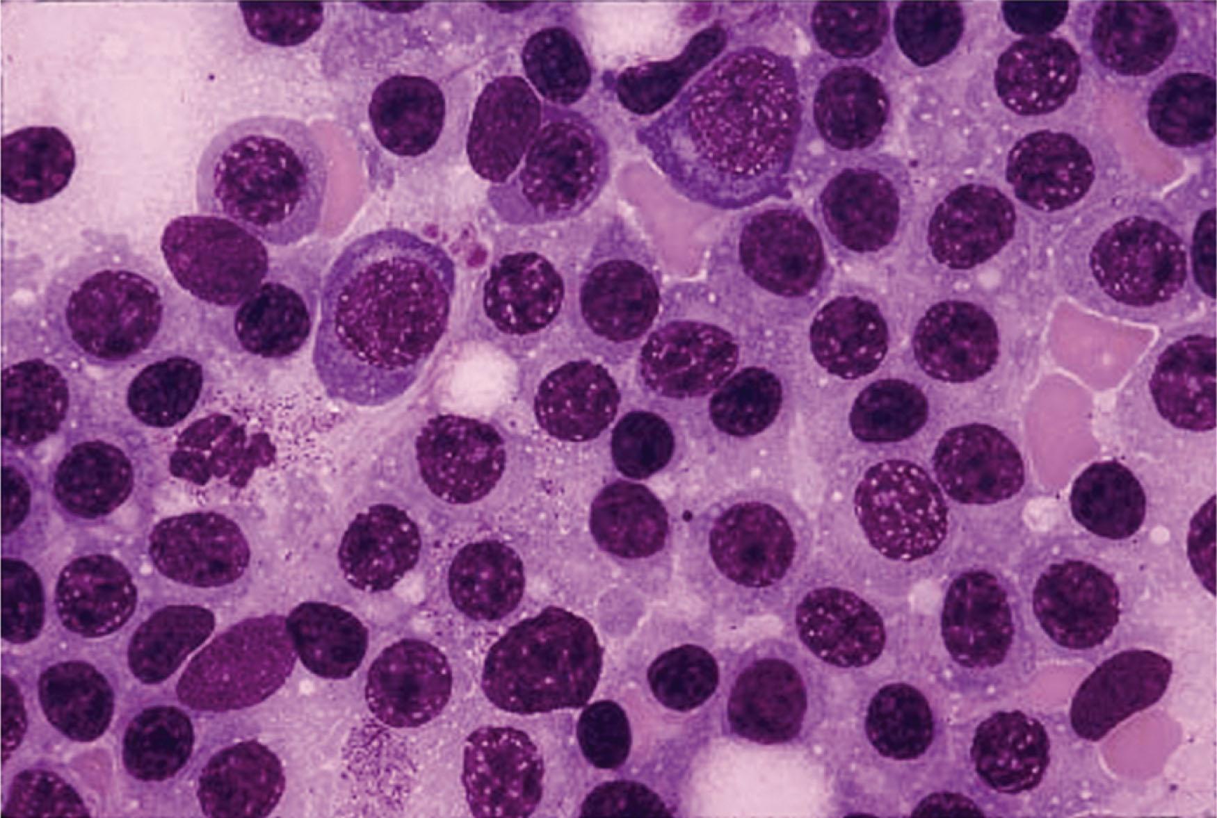 Figure 92.1, MARROW FILM FROM A PATIENT WITH WALDENSTRÖM MACROGLOBULINEMIA.