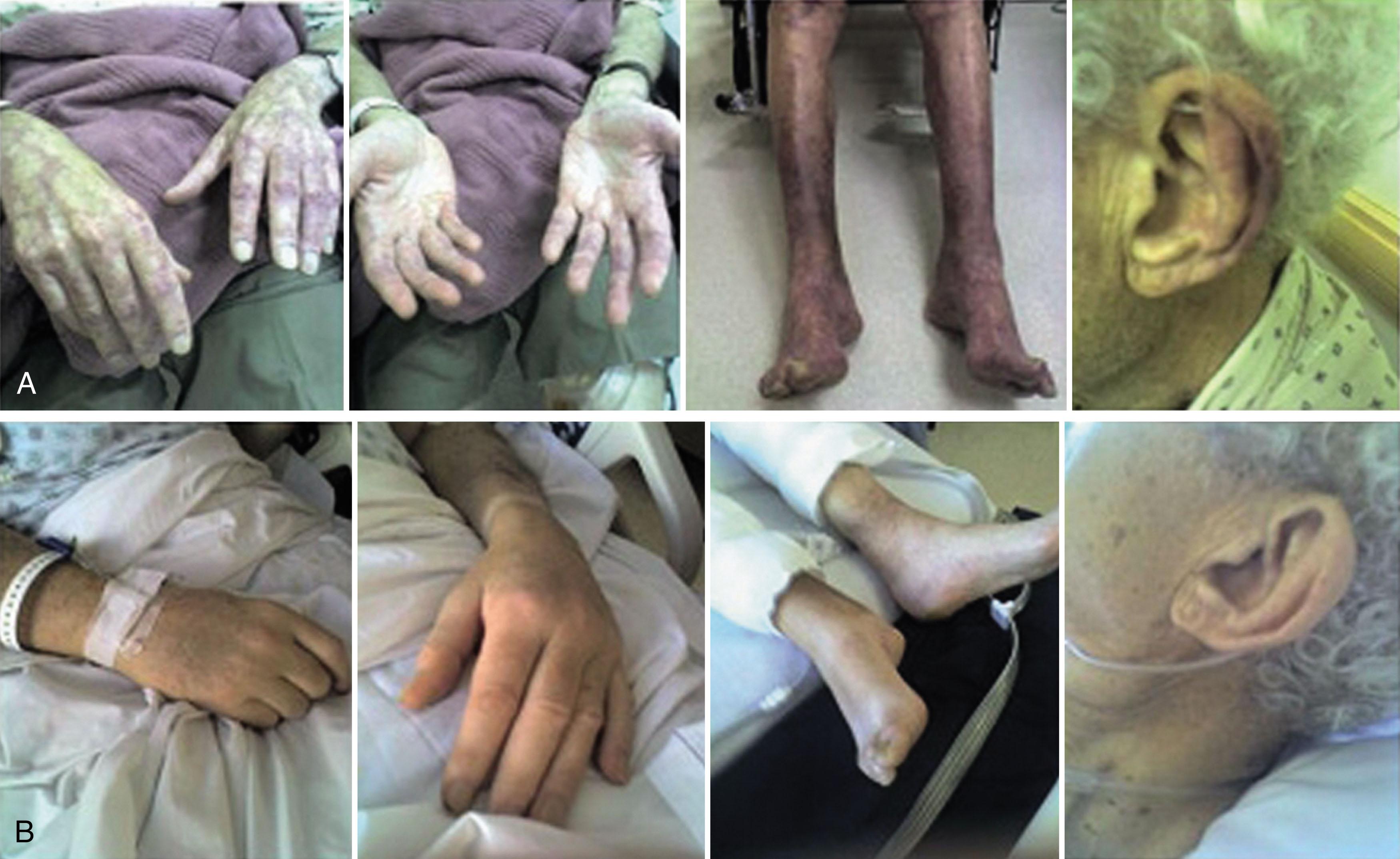 Figure 92.4, Cryoglobulinemia manifesting with severe acrocyanosis in a patient with Waldenström macroglobulinemia (A) before and (B) following warming and plasmapheresis.