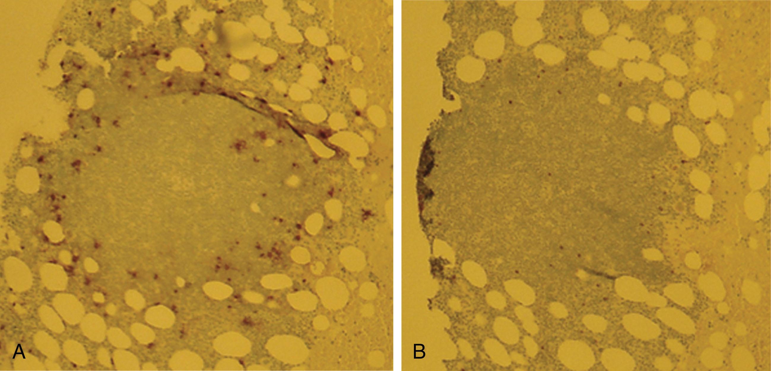 Figure 92.5, MARROW CLOT SECTION.