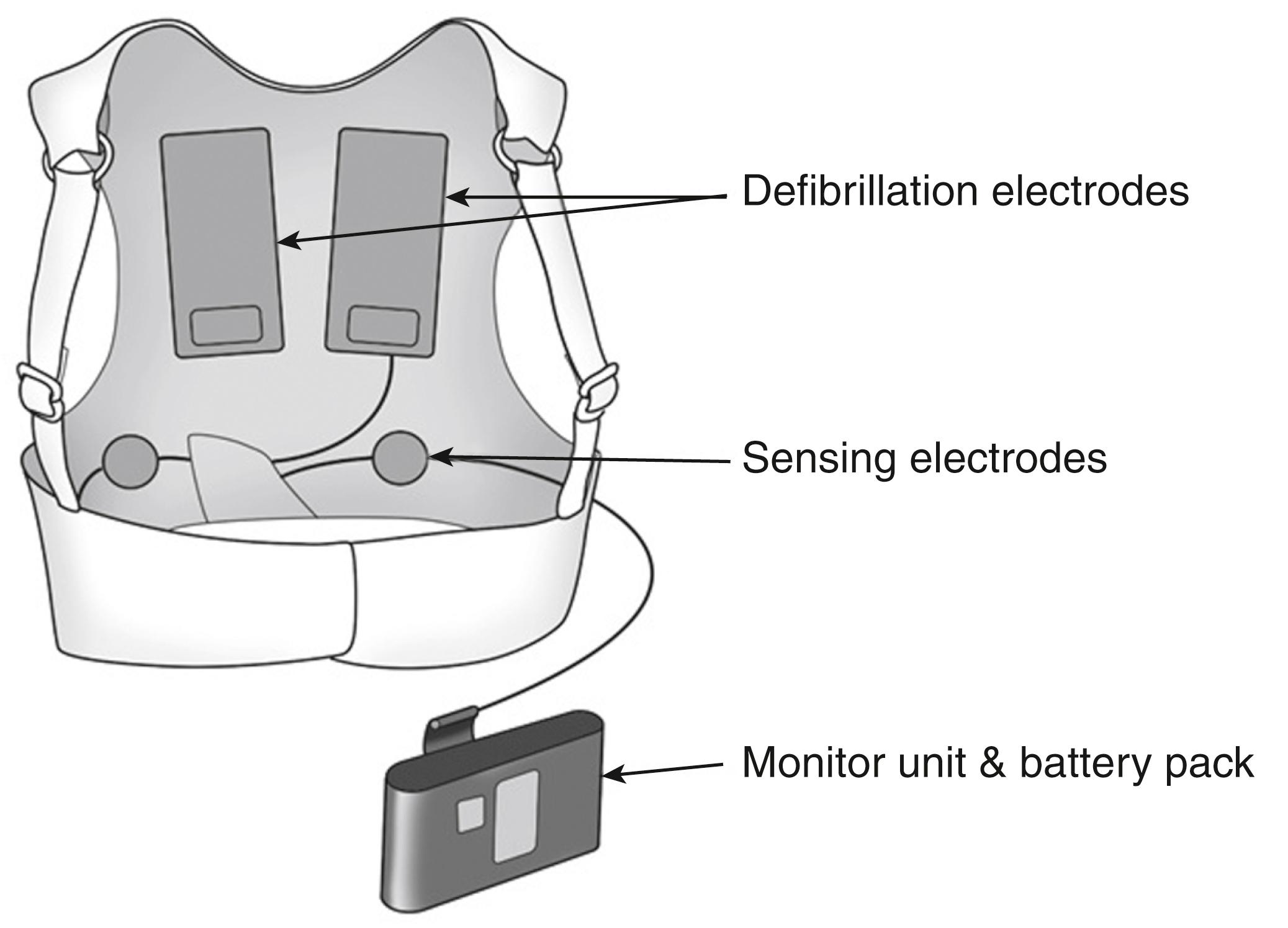 Fig. 124.1, Components of the wearable cardioverter-defibrillator, including washable interchangeable garment, self-gelling defibrillation electrodes, electrocardiogram electrodes, and rechargeable monitor and battery pack.