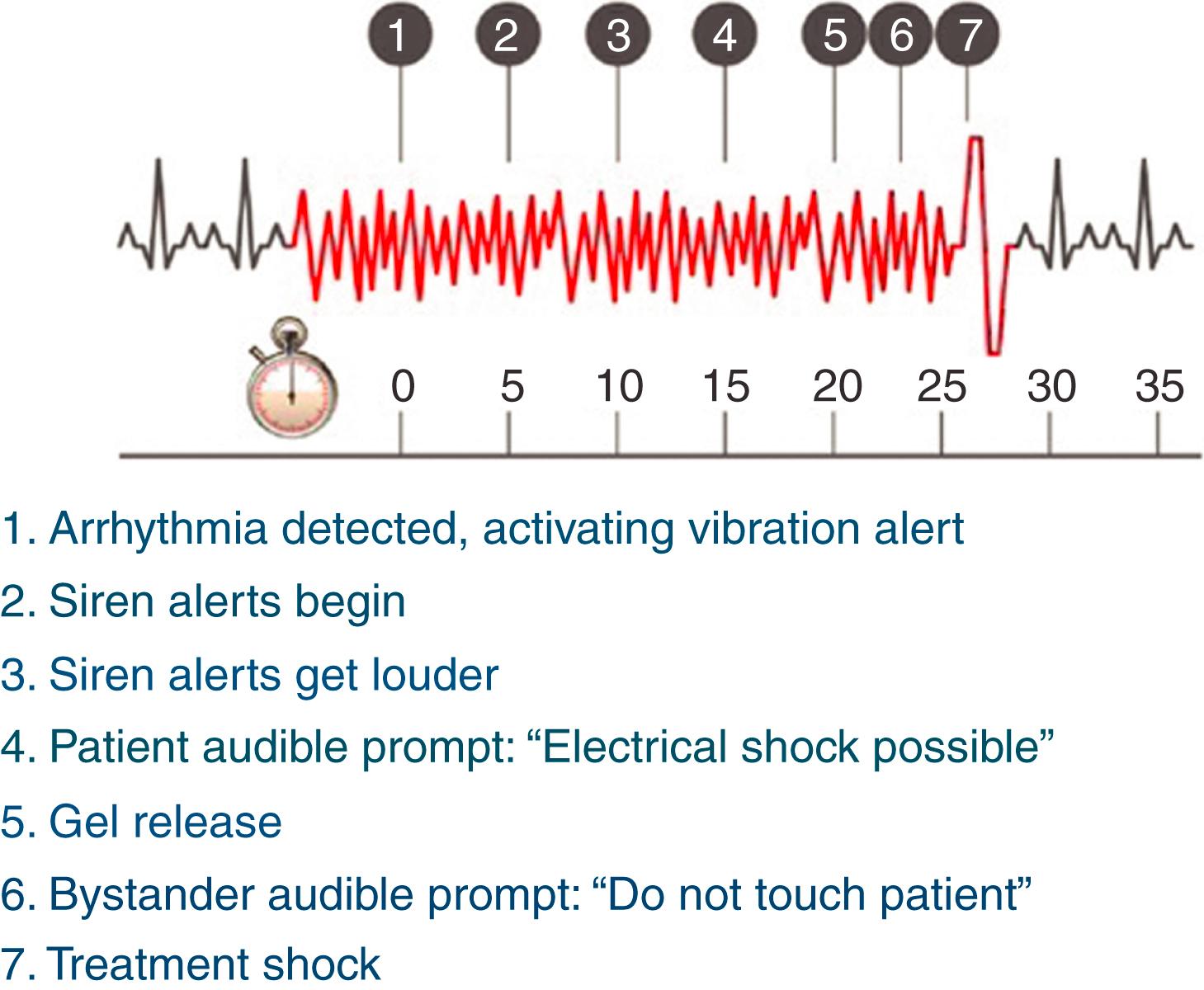 Fig. 124.2, Arrhythmia detection, alarm, and defibrillation sequence with wearable cardioverter-defibrillator.