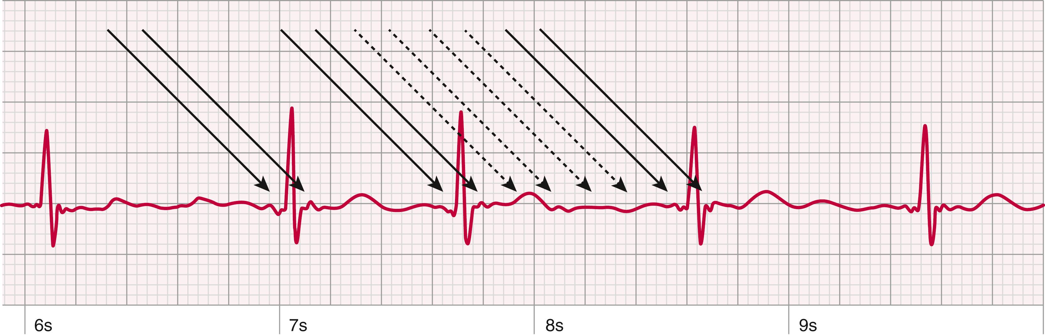 FIGURE 12.4, Atrial tachycardia misdiagnosed as atrial fibrillation due to filter attenuation. Careful observation of this Apple Watch electrocardiogram (ECG) rhythm strip identifies discrete organized atrial activity denoted by the solid arrows. The dashed arrows indicate atrial activity that appears attenuated due to filtering. A 12-lead ECG identified a macro-reentrant stable atrial tachycardia. Watch sampling was 513 Hz with 10 mm/mV gain and 25 mm/sec paper speed.
