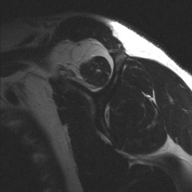 FIG. 4.1, Demonstration of atrophy and fatty infiltration of the supraspinatus visible on sagittal magnetic resonance imaging in a chronic tear.