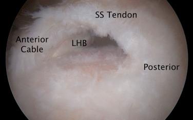 FIG. 4.2, Arthroscopic view of a full-thickness supraspinatus tear with an intact anterior cable. LHB, Long head of the biceps; SS, supraspinatus.