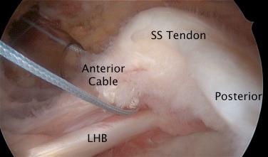 FIG. 4.3, Arthroscopic view of a full-thickness supraspinatus (SS) tear involving the anterior cable, as evidenced by the fact that the tear propagates to the tendon of the long head of the biceps (LHB) .