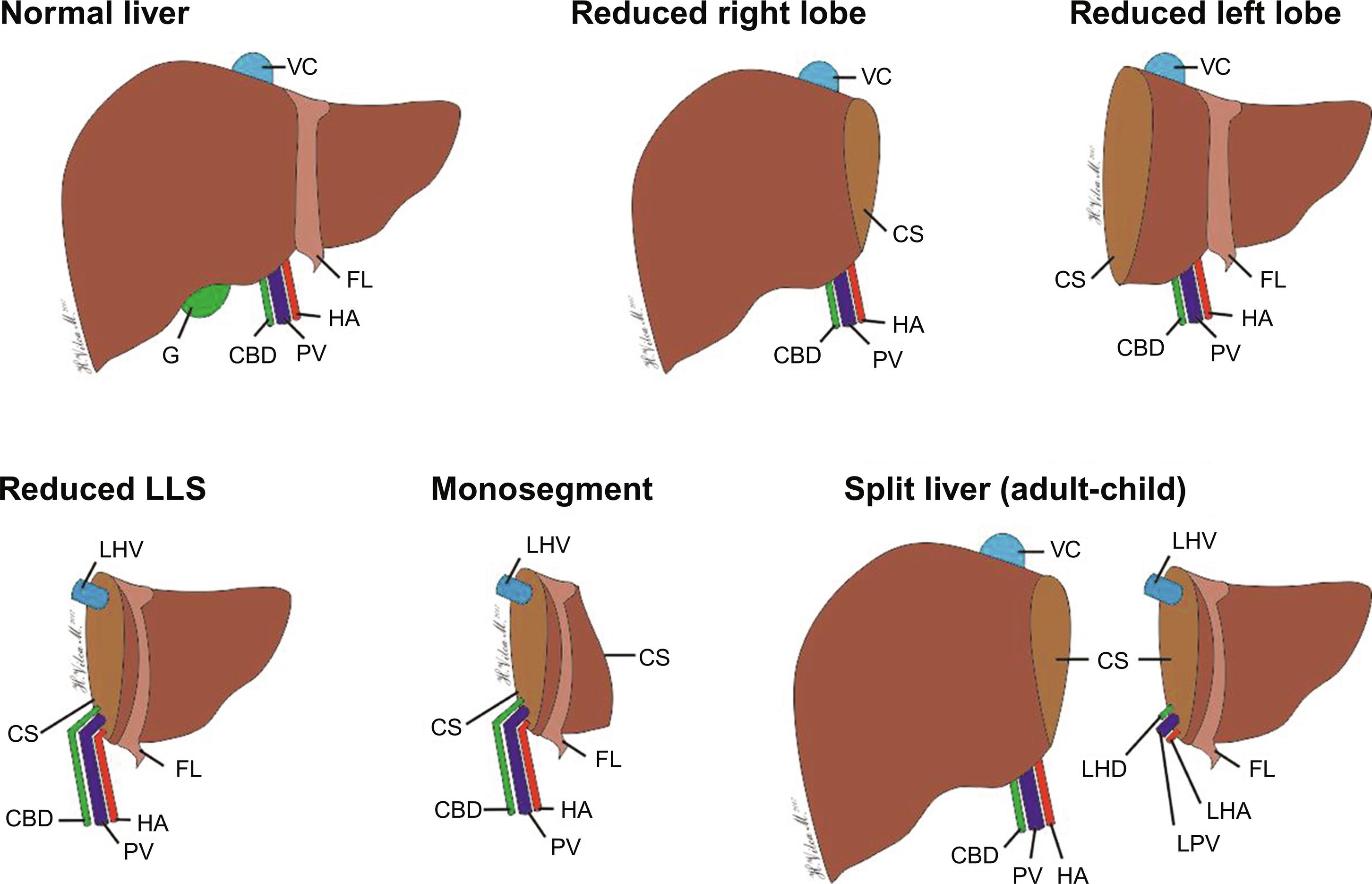 Fig. 2.1, Liver graft reduction and split techniques. CBD, Common bile duct; CS, cut surface; FL, falciform ligament; G, Gallbladder; HA, hepatic artery; LHA, left hepatic artery. LHD, left hepatic duct; LHV, left hepatic vein; LPV, left portal vein; PV, portal vein; VC, vena cava.