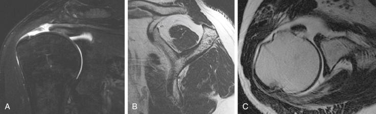 FIG. 16.1, Magnetic resonance images of a right shoulder. (A) Oblique coronal T2-weighted fat suppression image of supraspinatus tendon demonstrating retraction of the tendon medially. (B) Oblique sagittal T2-weighted image showing atrophy of supraspinatus and subscapularis tendons. (C) Axial T2-weighted image demonstrating a full-thickness subscapularis tendon tear and dislocated biceps tendon.