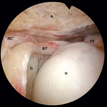 FIG. 16.2, Arthroscopic view of a right shoulder demonstrating a massive rotator cuff tear. A, Acromion; BT, biceps tendon; FP, rotator cuff footprint; G, glenoid; H, humeral head; RC, rotator cuff tendon.