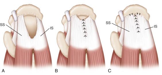 FIG. 16.3, U-shaped rotator cuff tear. (A) Superior view of a U-shaped rotator cuff tear involving the supraspinatus (SS) and infraspinatus (IS) tendons. (B) U-shaped tears demonstrate excellent mobility from an anterior-to-posterior direction and are initially repaired with side-to-side sutures using the principle of margin convergence. (C) The repaired margin is then repaired to bone in a tension-free manner.