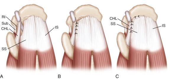 FIG. 16.4, Acute L-shaped rotator cuff tear. (A) Superior view of an acute L-shaped rotator cuff tear involving the supraspinatus tendon (SS) and rotator interval (RI) . (B) The tears should be initially repaired along the longitudinal split. (C) The converged margin is then repaired to bone. CHL, Coracohumeral ligament; IS, infraspinatus; Sub, subscapularis tendon.