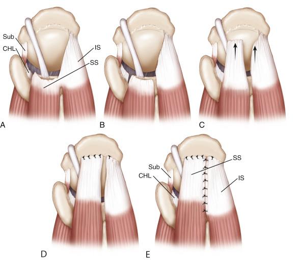 FIG. 16.5, Massive, contracted crescent rotator cuff tear. (A) Superior view. (B) A double-interval slide is performed by first performing an anterior interval slide (as described in Fig. 16.11 ) and then a posterior interval slide, releasing the interval between the supraspinatus (SS) and infraspinatus (IS) tendons. (C) After release, there is improved mobility (arrows) of the supraspinatus tendon and the infraspinatus and teres minor tendons posteriorly. (D) The supraspinatus tendon can then be repaired to a lateral bone bed in a tension-free manner, and the infraspinatus and teres minor tendons are advanced laterally and superiorly. (E) The residual defect is then closed with side-to-side sutures. CHL, Coracohumeral ligament; Sub, subscapularis tendon.
