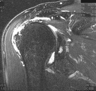 FIG. 23.2, Coronal MRI of an “at-risk” tendon considered for augmentation. This patient has a large retear after prior repair. Although the remaining tendon can likely be reapproximated back to bone, the risk of nonhealing is high because of poor tissue quality.