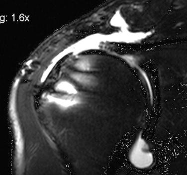 FIG. 23.3, Coronal MRI of a failure following a double-row repair. A segment of nonfunctional tendon remains attached to the greater tuberosity while the medial tendon is shortened and retracted with the supraspinatus muscle. It is unlikely that the remaining tendon will be reducible to the tuberosity without excessive tension, and therefore this patient will likely need an interposition dermal allograft.
