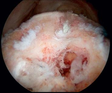 FIG. 23.4, Viewing from the lateral portal on a left shoulder, the rotator cuff footprint is visualized with cystic changes and prior implants from failed repairs. The articular edge is visualized on the horizon with the scapular spine in the background. The scapular spine serves as a reference to the native tendon midpoint and will be used while passing sutures.