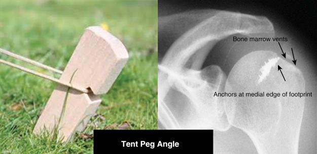 FIG. 23.5, The suture anchors are inserted 5 mm lateral to the articular cartilage at a 45-degree “tent peg” angle.