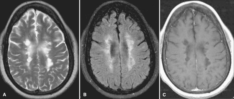 Fig. 24.1, MRI: Chronic relapsing remitting MS. T2-weighted image (A) and FLAIR (B) MR images demonstrating confluent hyperintensities in the periventricular white matter, with corresponding “black holes” on the T1-weighted MR image (C).
