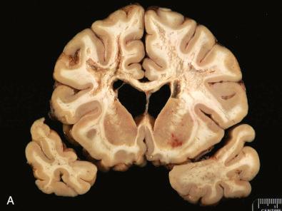 Fig. 24.11, NMO spectrum disorder. (A) Frontal lobe white matter shows myelin loss and cavitation. (B, C) Margin of inflammatory destructive NMO lesion (B, arrows ) is accompanied by unusual perivascular inflammation in which eosinophils are prominent (C) (H & E, B, 10×; C, 60×).