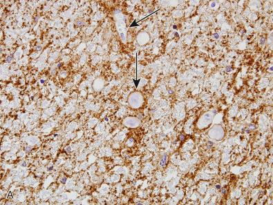 Fig. 24.12, Astrocytopathy, NMO spectrum disorder. (A) Punctate astrocytic processes cluster around small blood vessels (arrows) in control spinal cord (APQ4, 60×). (B, C) Adjacent sections of white matter stained for aquaporin4 (B) and GFAP (C) show parallel loss of immunoreactivity (B and C, 4×). (D, E) In classic RRMS, areas of demyelination (D, LFB-PAS) represent areas of increased GFAP immunoreactivity (E; D and E, 10×). (F, G) Marked disruption of AQP4 processes in parenchyma and perivascular distribution with swollen astrocytic cell bodies ( arrows, F) and end-feet ( arrows, G; AQP4 immunostain, F, 40×; G, 100×). (H) Prominent swollen perivascular processes ( arrows, H; GFAP immunostain, 40×). (I) Astrocytic clasmatodendrosis (GFAP, 40×).