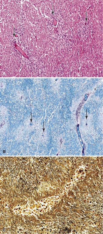 Fig. 24.13, Acute disseminated encephalomyelitis (ADEM). (A) Perivenous pallor, collections of inflammatory cells, and macrophages may be subtle in routine stains ( arrows; H & E, 20×). (B) Perivenous myelin pallor and inflammatory cells are prominent in sections stained for myelin ( arrows; LFB-PAS, 20×). (C) Even in the presence of significant demyelination, perivascular axonal preservation is typical (Bielschowsky, 40×).