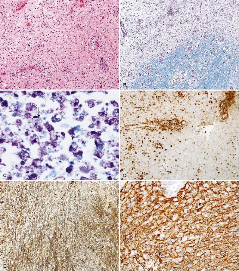 Fig. 24.2, Active multiple sclerosis plaque margin. (A) The margins of an active MS plaque are cellular due to the parenchymal and perivascular infiltration of lymphocytes, monocytes/macrophages, and astrocytes (H & E, 20×). (B) The edge of the active plaque is more discrete than would be expected in a neoplasm but not as sharp as an inactive MS plaque (LFB-PAS, 10×). (C) At the plaque margin, fragments of myelin (arrows) are phagocytosed by macrophages (LFB-PAS, 100×). (D) Macrophages, found in great numbers in the margins of the plaque, are found in a perivascular and parenchymal distribution (CD68 immunostain, 20×). (E) A sequential section to Fig. 24.2B shows relative axonal preservation within the area completely lacking in myelin (Bielschowsky silver stain for axons, 10×). (F) Higher magnification of the plaque edge demonstrates scattered axonal swellings (arrows), evidence that axonopathy is an important part of the demyelinating process (neurofilament immunostain, 40×). (G) Lymphocytic cuffing of the microvasculature (LFB-PAS, 40×). (H) Most lymphocytes in perivascular and parenchymal distribution are T cells (CD3 immunostain, 20×). (I) Reactive astrocytes (arrows) contribute to plaque cellularity (H & E, 40×). (J) Immunostaining for GFAP demonstrates gemistocytes and large numbers of glial processes (GFAP immunostain, 40×). (K) Creutzfeldt cells (arrow) should not be misinterpreted as mitoses in an astrocytoma (H & E, 60×).