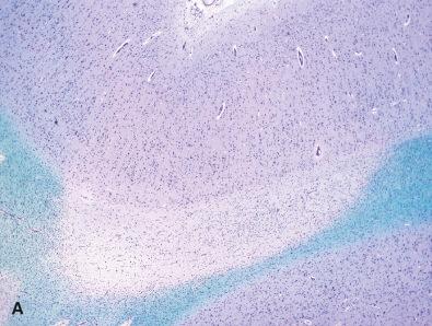 Fig. 24.3, Cortical MS plaques. (A) Routine stains demonstrate a subcortical white matter myelin plaque but the overlying cortex appears deceptively spared (LFB-PAS, 4×). (B) Demonstration of myelin basic protein shows that the white matter plaque extends into the overlying cortex (MBP immunostain, 4×). (C) Higher magnification view of the border of the plaque shows a sharp border with little evidence of ongoing demyelinative activity (MBP immunostain, 40×). (D) Occasional actively demyelinating subcortical lesions may induce prominent microglial response (arrows) in contiguous cortex (CD68 immunostain, 20×).