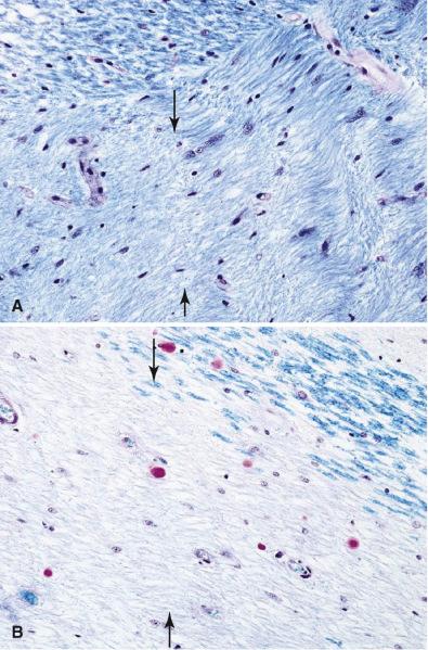 Fig. 24.4, Remyelination of MS plaques (“shadow plaque”). (A, B) The margin of a shadow plaque contains delicate myelin ( arrows, A) in the absence of macrophages representing remyelination, compared to a typical plaque lacking remyelination ( arrows, B; LFB-PAS, 40×).