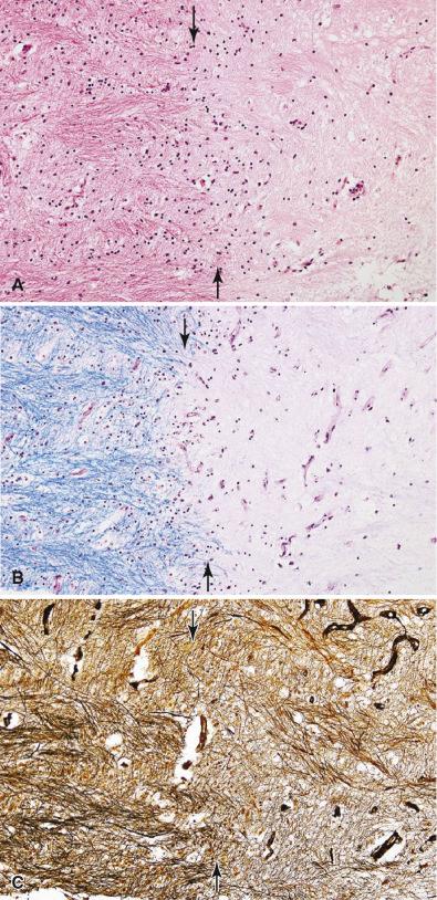 Fig. 24.5, Chronic inactive MS plaque viewed in sequential sections. (A) The margins (arrows) of inactive plaques are sharp without inflammation and macrophages (H & E, 20×). (B) Myelin loss within the plaque is nearly complete with oligodendroglia present only at the plaque margin ( arrows; LFB-PAS, 20×). (C) At the edge of a plaque (arrows), there is relative axon preservation and no axon swellings (Bielschowsky, 20×).