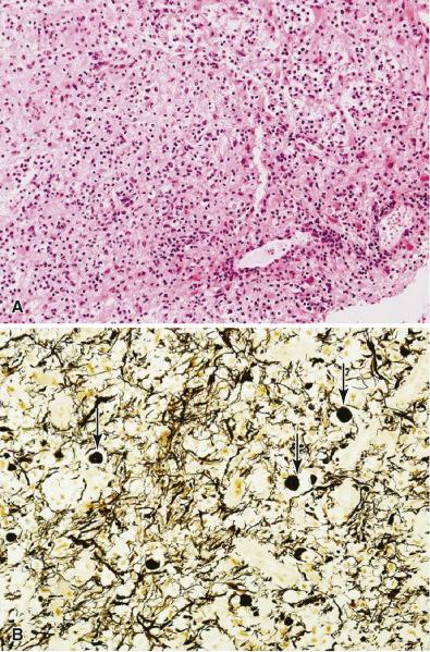 Fig. 24.6, Histologic appearance of acute MS. (A) In acute MS, the large areas of demyelination resemble the acute edge of active MS plaques with macrophages, T and B cells, edema, and astrocytosis (H & E, 20×). (B) Axonopathy is frequently prominent with numerous axonal spheroids ( arrows, Bielschowsky, 40×).