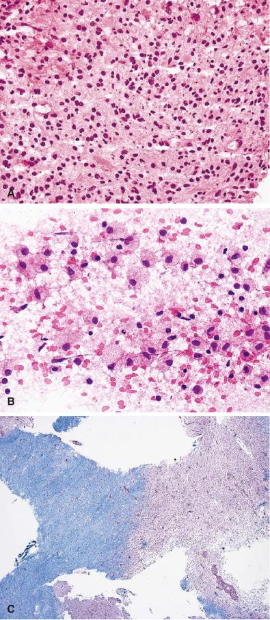 Fig. 24.7, Inflammatory demyelinating mass clinically presenting as glioma. (A) Frozen sections of demyelinating processes may be mistaken for a diffusely infiltrating glioma with pleomorphic nuclei and a fibrillary background (H & E, 40×). (B) An intraoperative touch preparation demonstrates numerous macrophages (H & E, 40×). (C) LFB-PAS histochemistry demonstrates the demyelinative edge of the process (LFB-PAS, 4×).