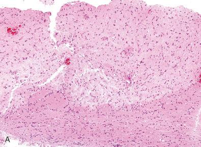 Fig. 24.8, Sentinel lesion. A questionable demyelinative lesion is shown stained for H & E (A), LFB-PAS (B), neurofilament (C), and macrophages (D, CD68; all 40×). (E, F) Fragment of lymphoma with focal necrosis adjacent to tissue sampled in Fig. 24.8A–D stained with H & E (E) and a B cell marker (F, CD20; all 40×).