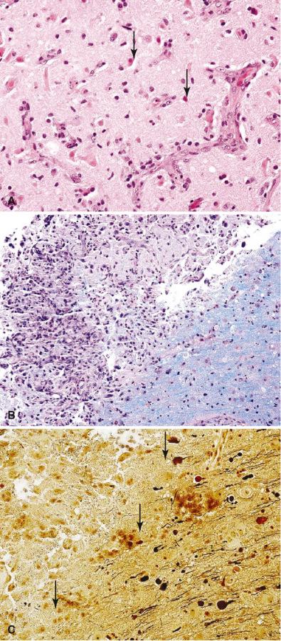 Fig. 24.10, Differential diagnosis: infarct. (A) Inclusion of gray matter with the white matter in this biopsy demonstrates eosinophilic neurons (arrows) and capillary proliferation (H & E, 40×). (B) Edge of an infarct demonstrates a sharp border with the adjacent white matter, which may mimic an active MS plaque (LFB-PAS, 20×). (C) The clearest difference with a demyelinative process is the granular debris, lack of axonal preservation, and numerous axonal spheroids at the margin edge ( arrows; Bielschowsky, 40×).