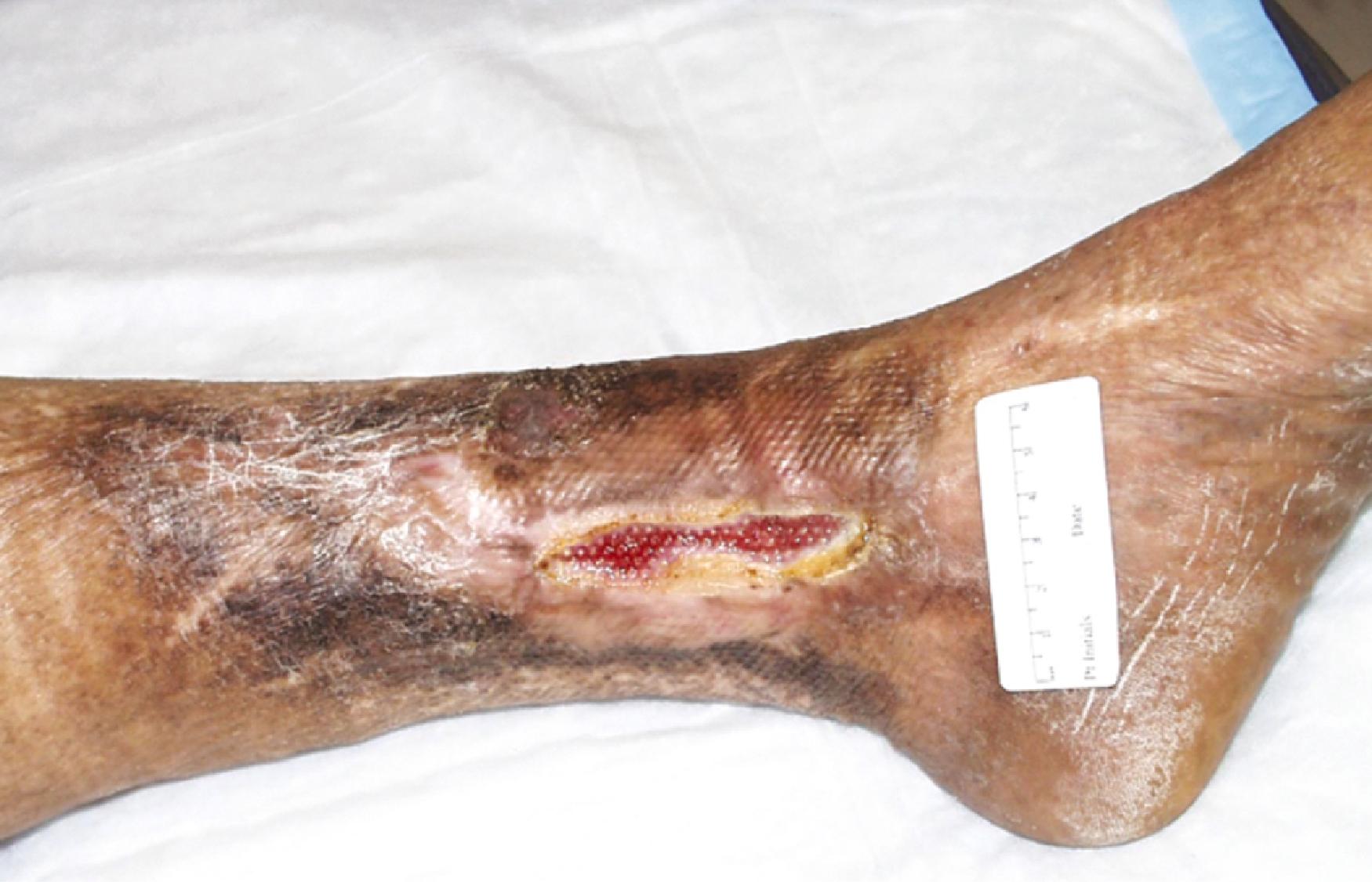 Figure 118.1, Limb with chronic venous insufficiency illustrating wound tissue scarring and lipodermatosclerosis.