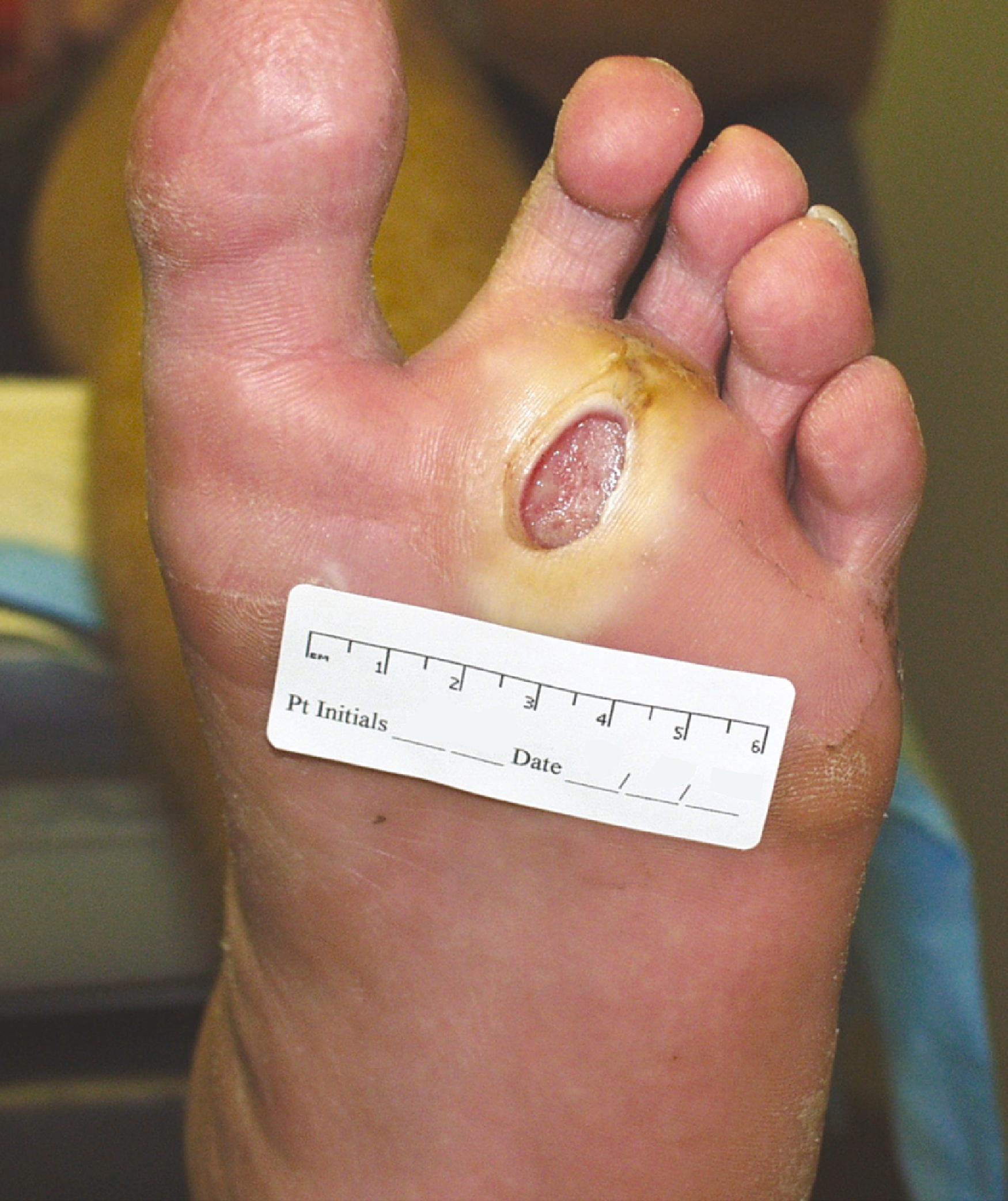 Figure 118.2, Wagner grade 1 diabetic foot ulcer. The wound penetrates through the full thickness of the skin, involving the subcutaneous tissue but not the deeper tissue layers.