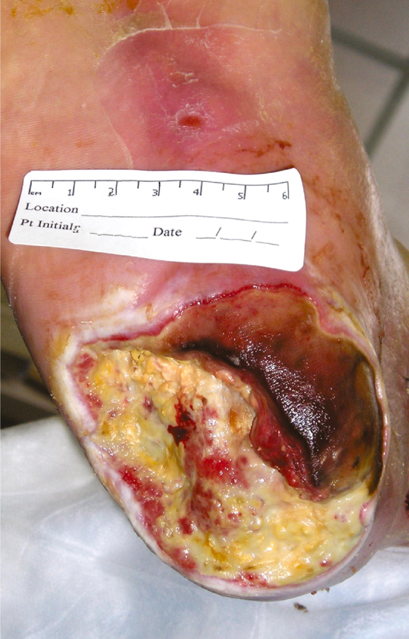 Figure 118.3, Complex heel ulcer with exposed tendon and infected bone.