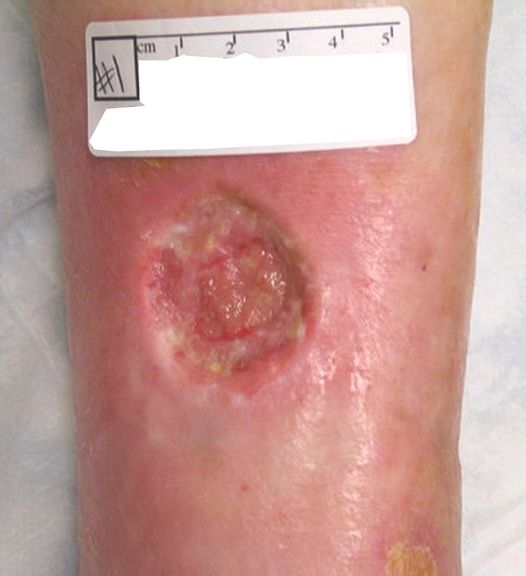 Figure 118.5, Chronic wound with squamous cell malignancy (Marjolin ulcer).
